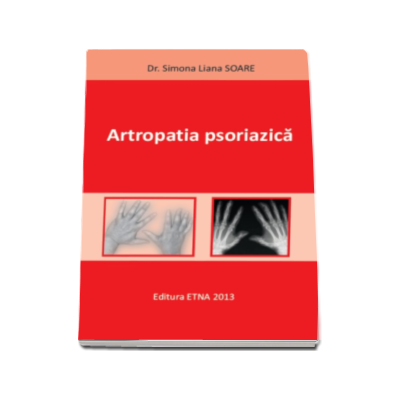 Artropatia psoriazica- Simona Liana Soare